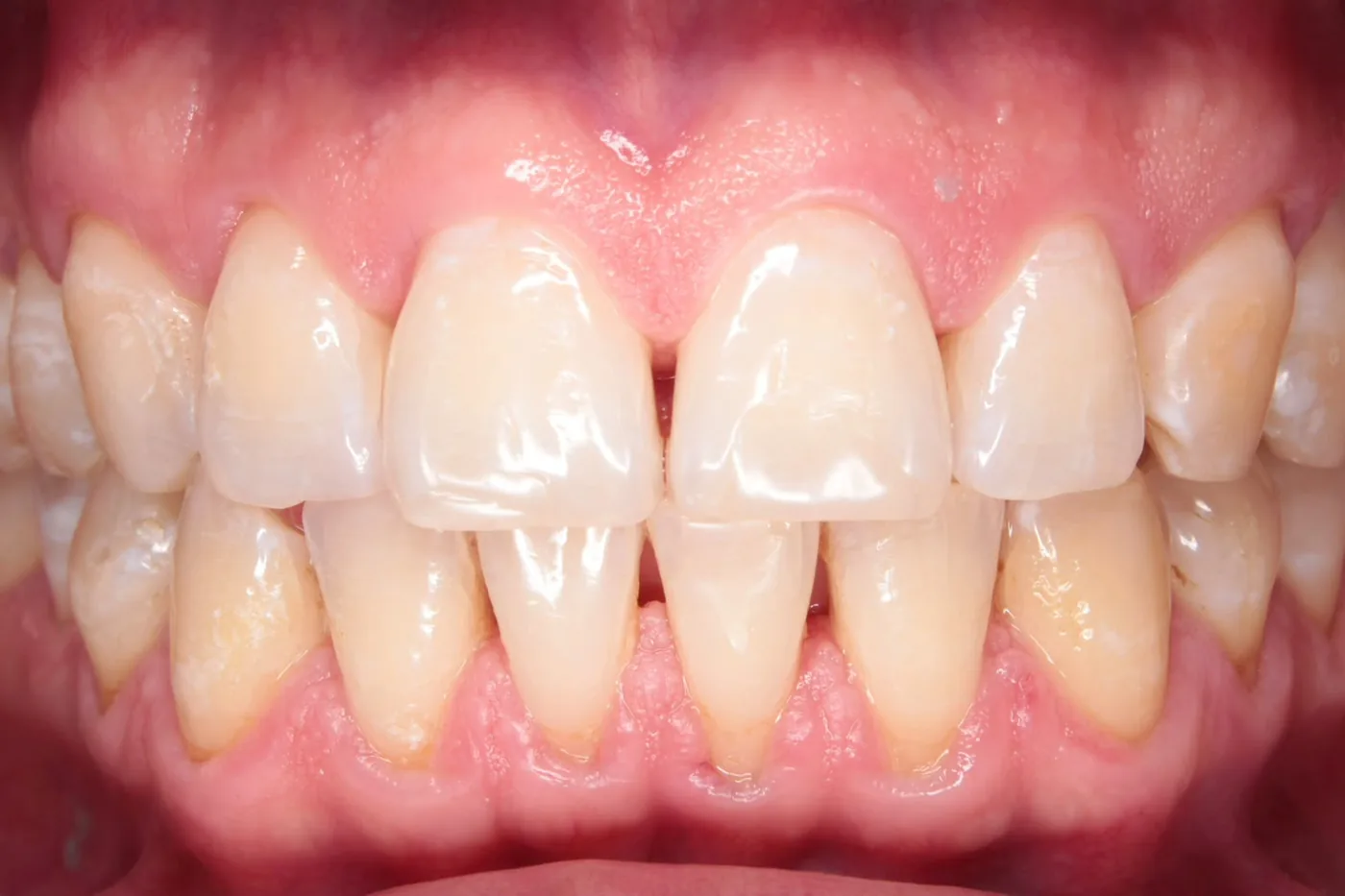 Después: el mismo paciente con dientes limpios y más claros