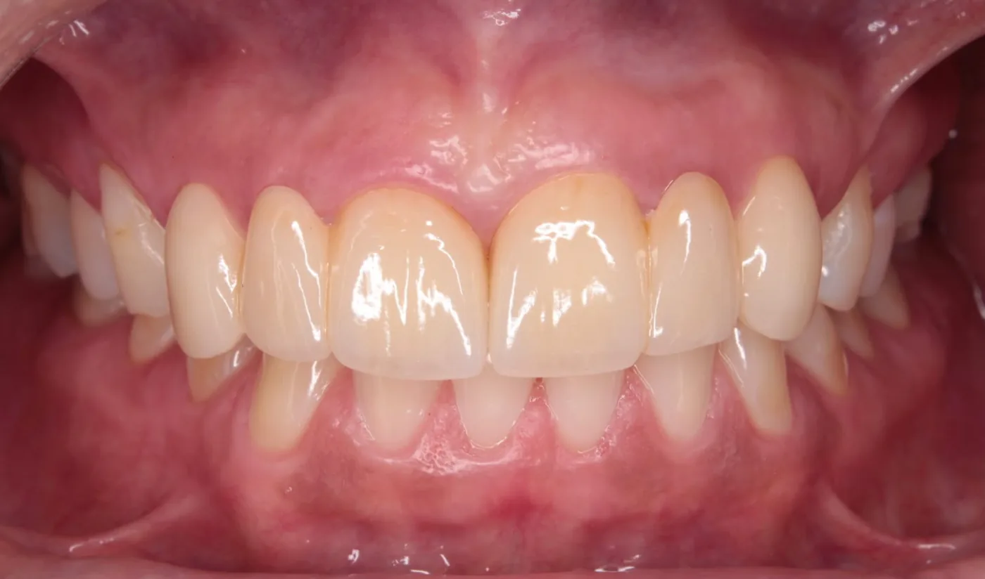 Prótesis fija de cerámica en los dientes superiores