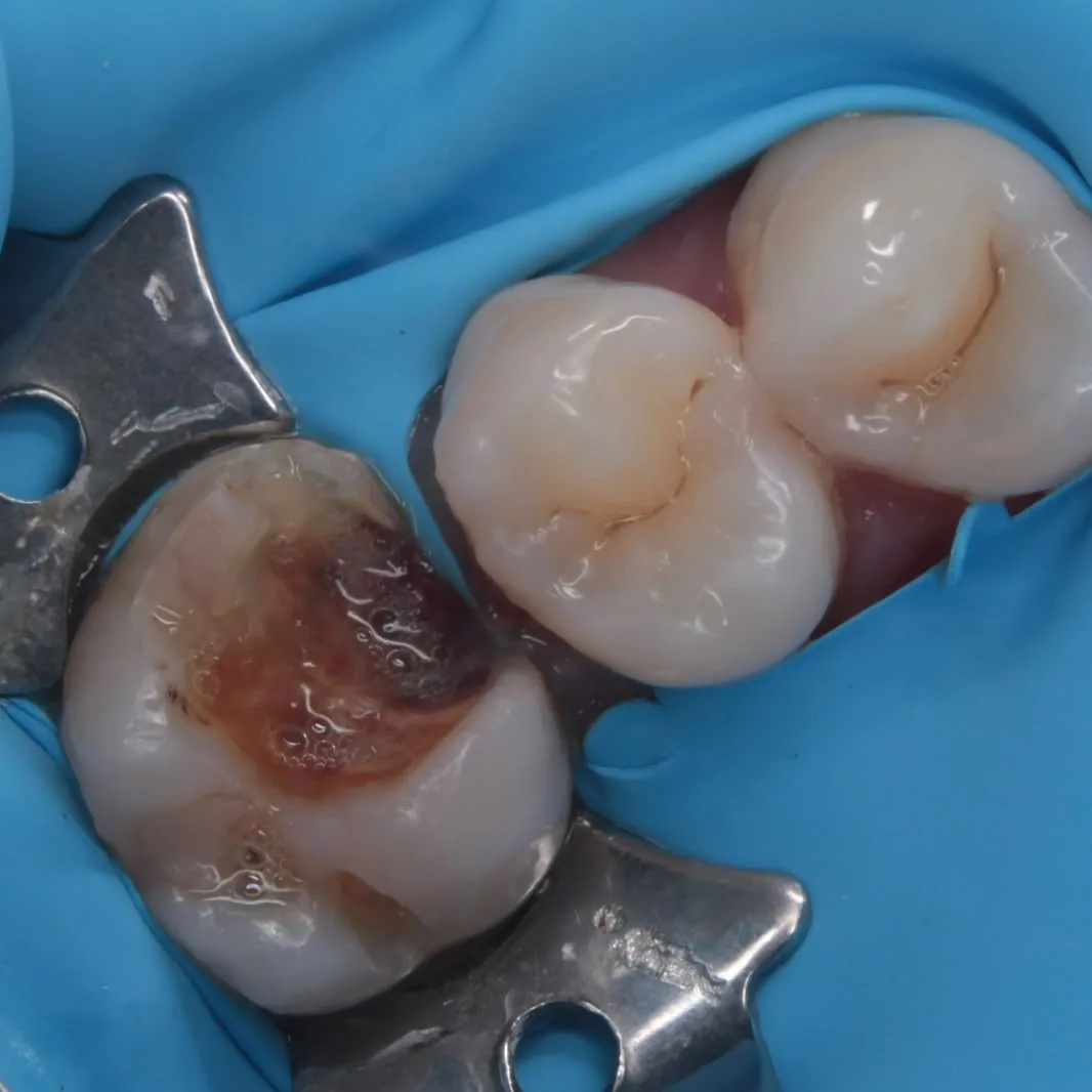 Antes: muela con caries, aislada para el tratamiento